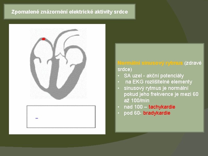 Zpomalené znázornění elektrické aktivity srdce Normální sinusový rytmus (zdravé srdce) • SA uzel -