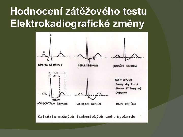 Hodnocení zátěžového testu Elektrokadiografické změny 