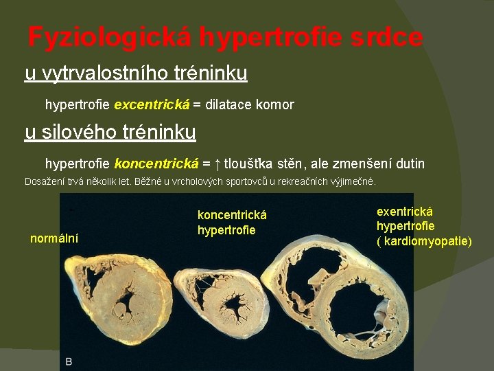 Fyziologická hypertrofie srdce u vytrvalostního tréninku hypertrofie excentrická = dilatace komor u silového tréninku