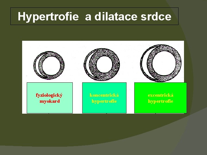 Hypertrofie a dilatace srdce fyziologický myokard koncentrická hypertrofie excentrická hypertrofie 