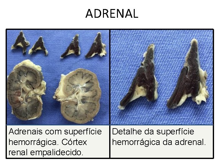 ADRENAL Adrenais com superfície hemorrágica. Córtex renal empalidecido. Detalhe da superfície hemorrágica da adrenal.