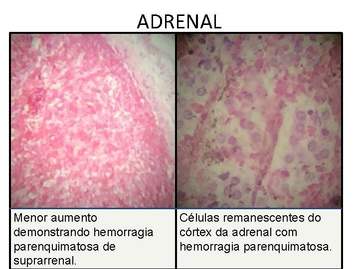 ADRENAL Menor aumento demonstrando hemorragia parenquimatosa de suprarrenal. Células remanescentes do córtex da adrenal