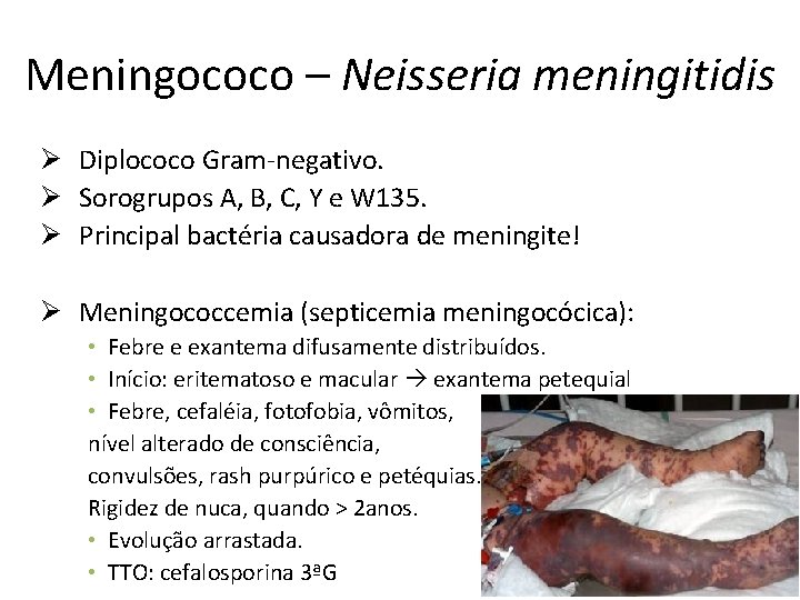 Meningococo – Neisseria meningitidis Ø Diplococo Gram-negativo. Ø Sorogrupos A, B, C, Y e