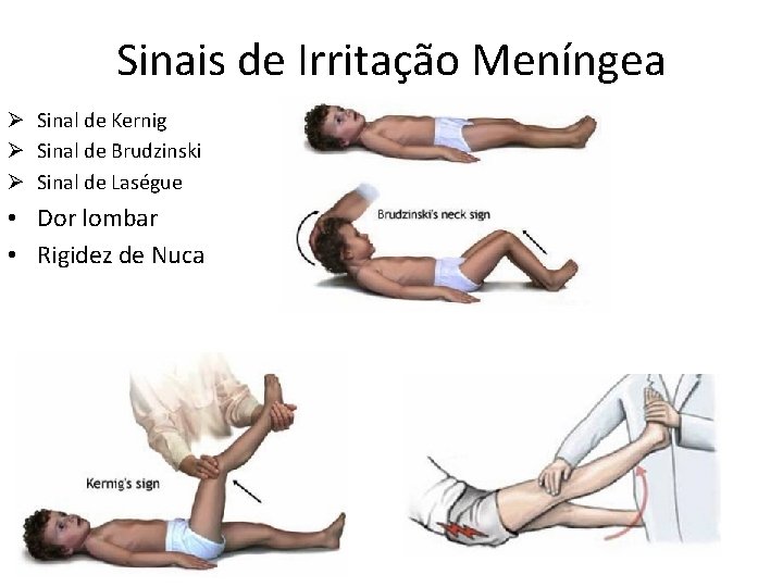 Sinais de Irritação Meníngea Ø Sinal de Kernig Ø Sinal de Brudzinski Ø Sinal