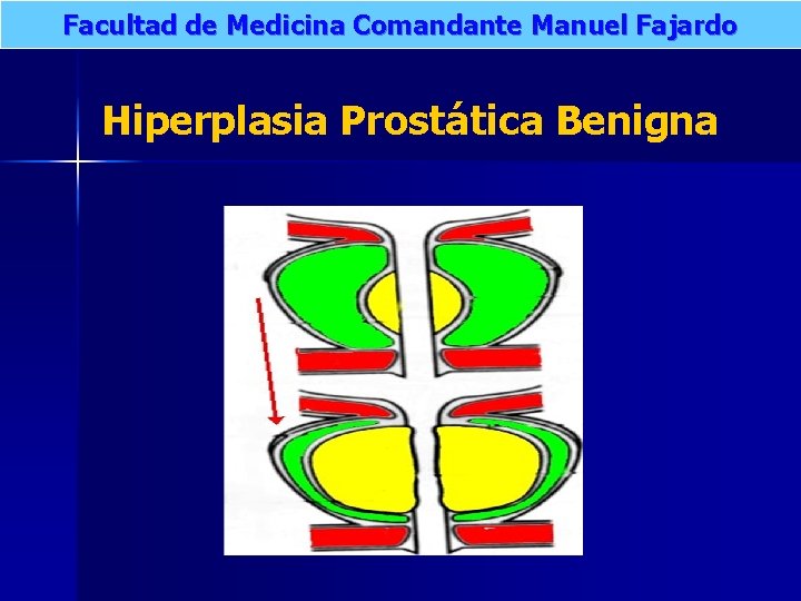 Facultad de Medicina Comandante Manuel Fajardo Hiperplasia Prostática Benigna 