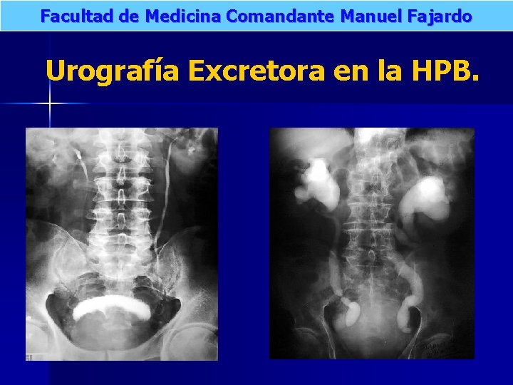 Facultad de Medicina Comandante Manuel Fajardo Urografía Excretora en la HPB. 