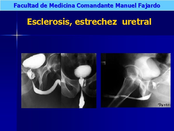 Facultad de Medicina Comandante Manuel Fajardo Esclerosis, estrechez uretral 