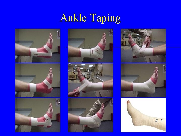 Ankle Taping 