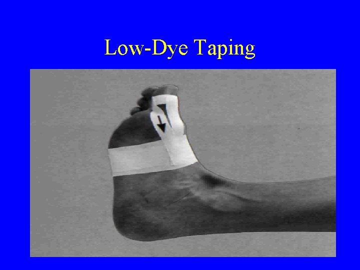 Low-Dye Taping 