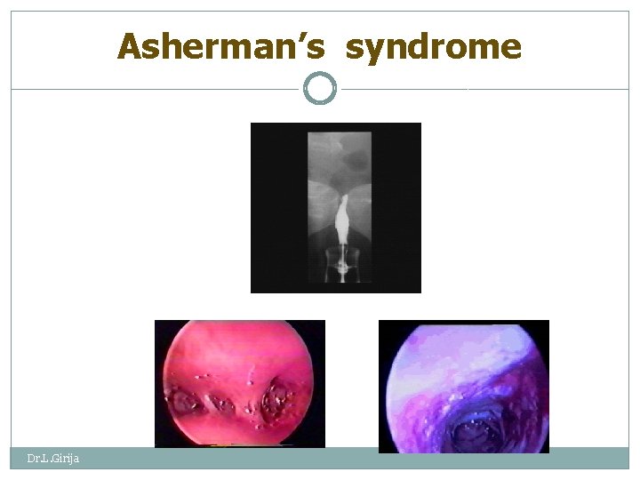 Asherman’s syndrome Dr. L. Girija 