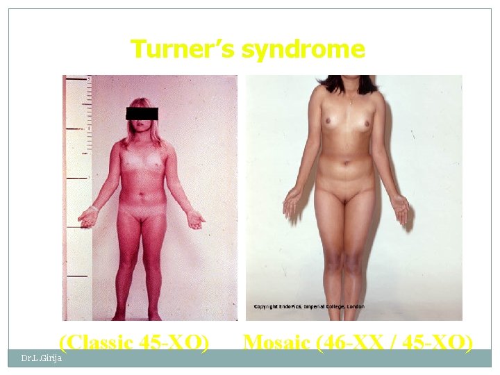 Turner’s syndrome (Classic 45 -XO) Dr. L. Girija Mosaic (46 -XX / 45 -XO)