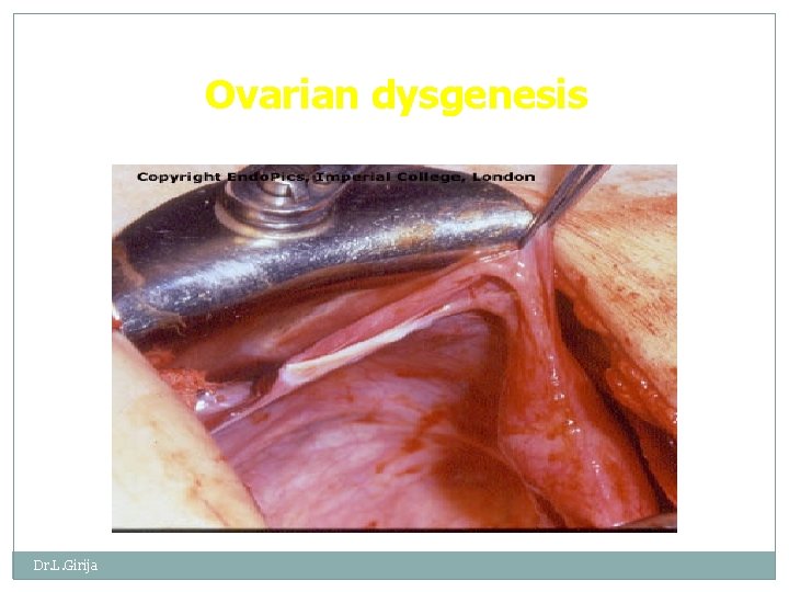 Ovarian dysgenesis Dr. L. Girija 