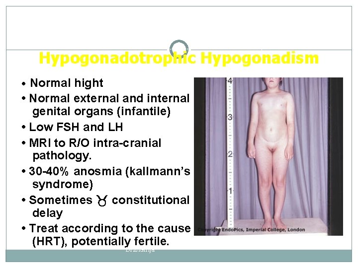 Hypogonadotrophic Hypogonadism Normal hight • Normal external and internal genital organs (infantile) • Low
