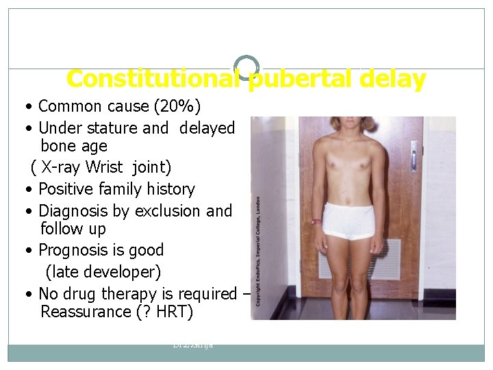 Constitutional pubertal delay • Common cause (20%) • Under stature and delayed bone age