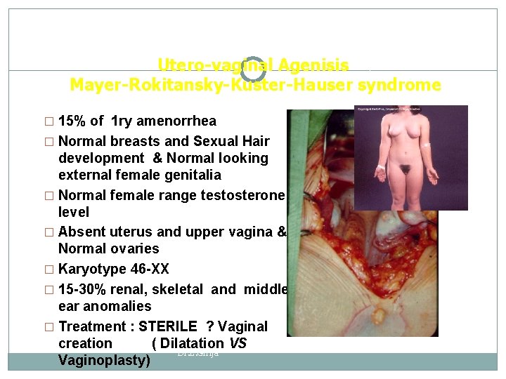 Utero-vaginal Agenisis Mayer-Rokitansky-Kuster-Hauser syndrome � 15% of 1 ry amenorrhea � Normal breasts and