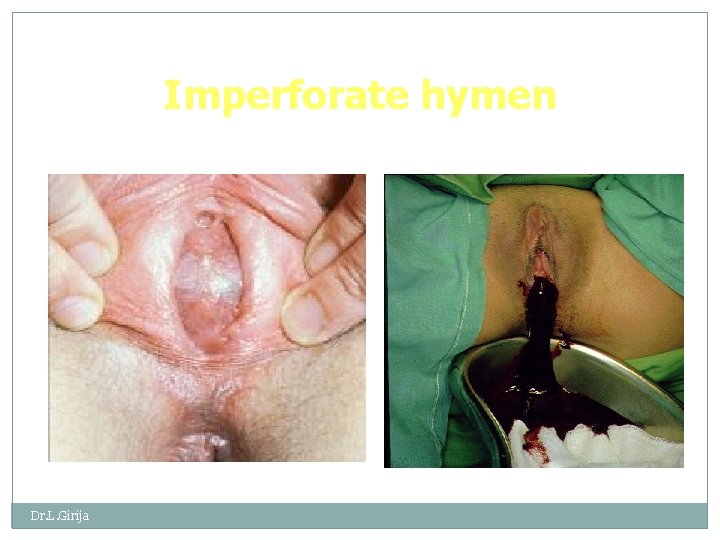 Imperforate hymen Dr. L. Girija 