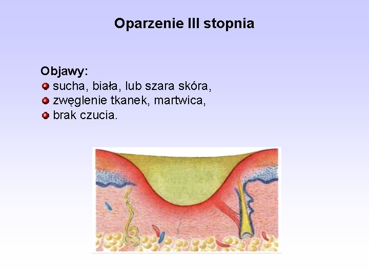 Oparzenie III stopnia Objawy: sucha, biała, lub szara skóra, zwęglenie tkanek, martwica, brak czucia.