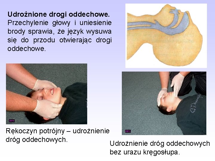 Udrożnione drogi oddechowe. Przechylenie głowy i uniesienie brody sprawia, że język wysuwa się do