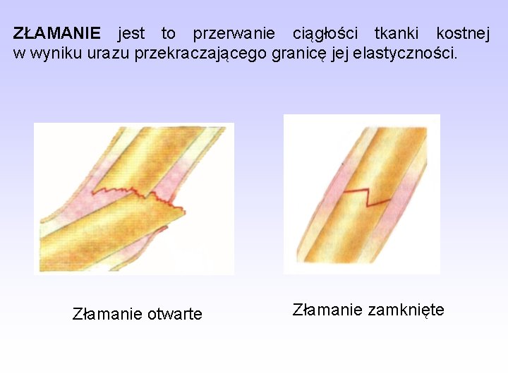 ZŁAMANIE jest to przerwanie ciągłości tkanki kostnej w wyniku urazu przekraczającego granicę jej elastyczności.