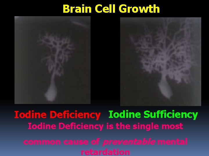 Brain Cell Growth Iodine Deficiency Iodine Sufficiency Iodine Deficiency is the single most common
