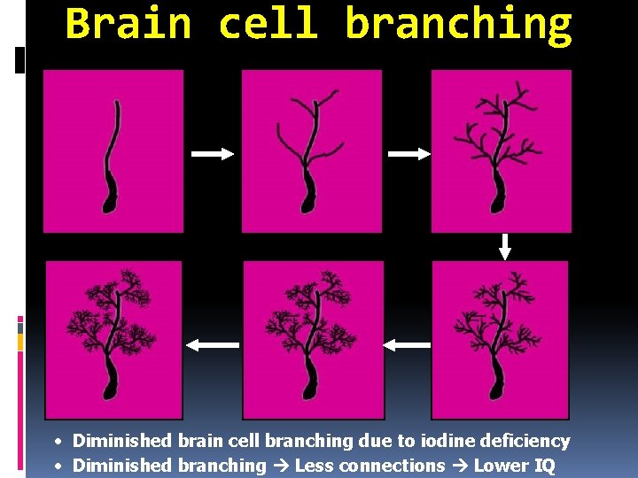 Brain cell branching • Diminished brain cell branching due to iodine deficiency • Diminished
