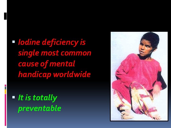  Iodine deficiency is single most common cause of mental handicap worldwide It is