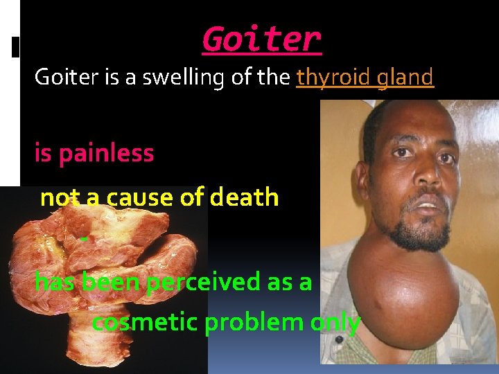Goiter is a swelling of the thyroid gland is painless not a cause of