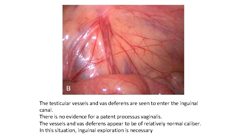 The testicular vessels and vas deferens are seen to enter the inguinal canal. There