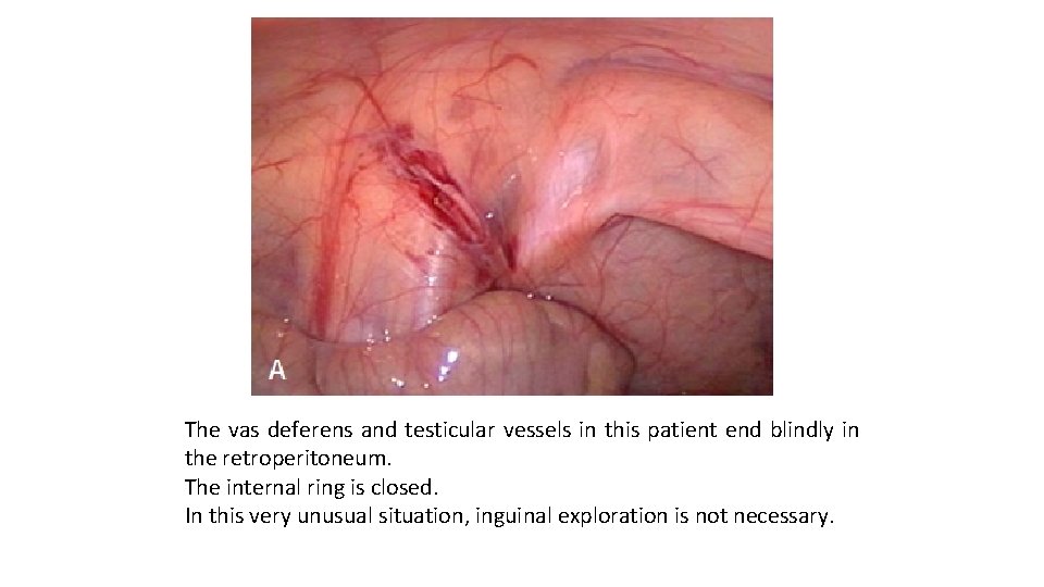 The vas deferens and testicular vessels in this patient end blindly in the retroperitoneum.