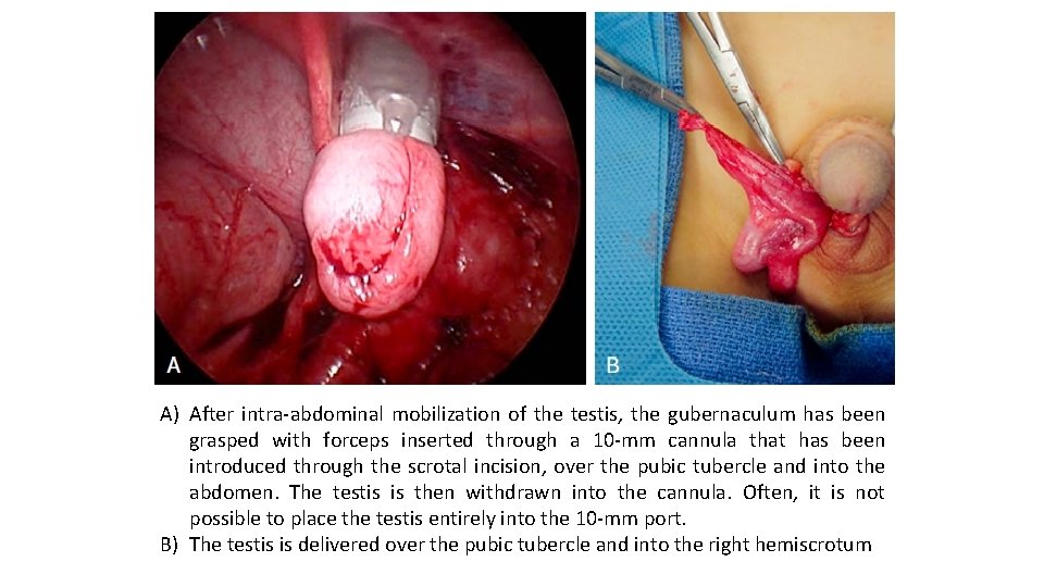 A) After intra-abdominal mobilization of the testis, the gubernaculum has been grasped with forceps