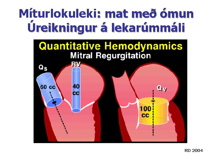 Míturlokuleki: mat með ómun Úreikningur á lekarúmmáli RD 2004 Míturlokuleki: mat með ómun Úreikningur á lekarúmmáli RD 2004