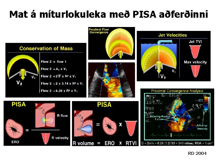 Mat á míturlokuleka með PISA aðferðinni RD 2004 Mat á míturlokuleka með PISA aðferðinni RD 2004