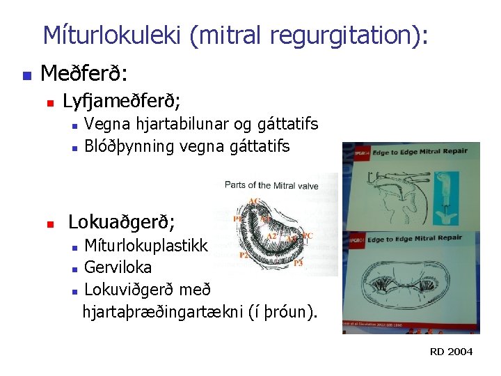 Míturlokuleki (mitral regurgitation): n Meðferð: n Lyfjameðferð; n n n Vegna hjartabilunar og gáttatifs Míturlokuleki (mitral regurgitation): n Meðferð: n Lyfjameðferð; n n n Vegna hjartabilunar og gáttatifs
