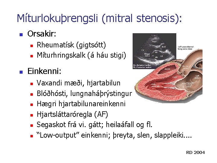 Míturlokuþrengsli (mitral stenosis): n Orsakir: n n n Rheumatísk (gigtsótt) Míturhringskalk (á háu stigi) Míturlokuþrengsli (mitral stenosis): n Orsakir: n n n Rheumatísk (gigtsótt) Míturhringskalk (á háu stigi)