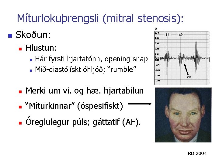 Míturlokuþrengsli (mitral stenosis): n Skoðun: n Hlustun: n n Hár fyrsti hjartatónn, opening snap Míturlokuþrengsli (mitral stenosis): n Skoðun: n Hlustun: n n Hár fyrsti hjartatónn, opening snap