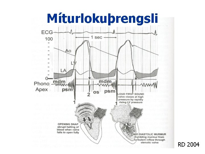 Míturlokuþrengsli RD 2004 Míturlokuþrengsli RD 2004