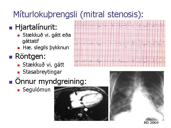 Míturlokuþrengsli (mitral stenosis): n Hjartalínurit: n n n Röntgen: n n n Stækkuð vi. Míturlokuþrengsli (mitral stenosis): n Hjartalínurit: n n n Röntgen: n n n Stækkuð vi.