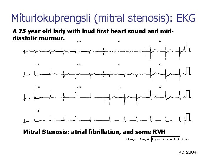 Míturlokuþrengsli (mitral stenosis): EKG A 75 year old lady with loud first heart sound Míturlokuþrengsli (mitral stenosis): EKG A 75 year old lady with loud first heart sound