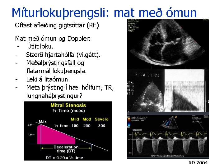 Míturlokuþrengsli: mat með ómun Oftast afleiðing gigtsóttar (RF) Mat með ómun og Doppler: - Míturlokuþrengsli: mat með ómun Oftast afleiðing gigtsóttar (RF) Mat með ómun og Doppler: -