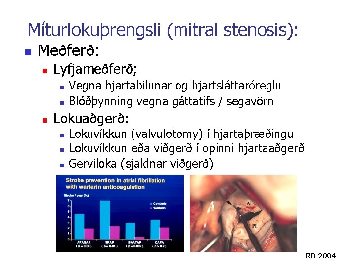 Míturlokuþrengsli (mitral stenosis): n Meðferð: n Lyfjameðferð; n n n Vegna hjartabilunar og hjartsláttaróreglu Míturlokuþrengsli (mitral stenosis): n Meðferð: n Lyfjameðferð; n n n Vegna hjartabilunar og hjartsláttaróreglu