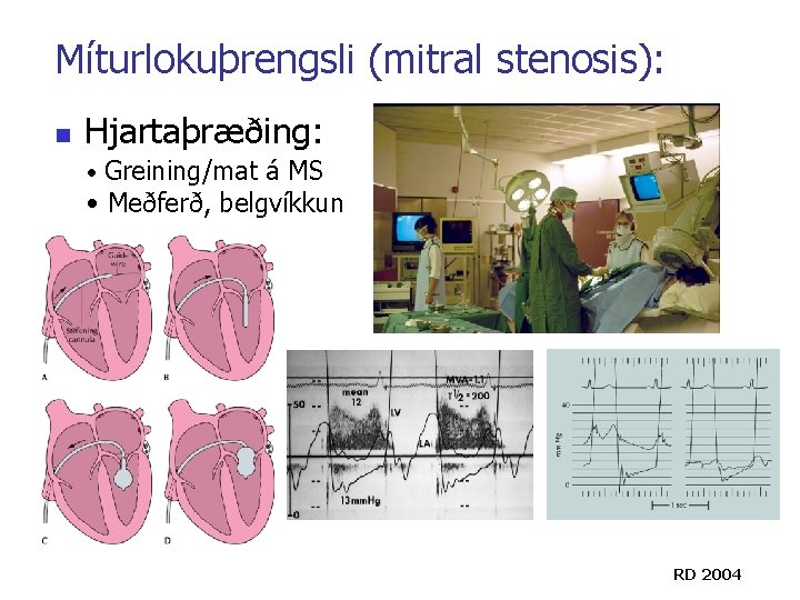 Míturlokuþrengsli (mitral stenosis): n Hjartaþræðing: • Greining/mat á MS • Meðferð, belgvíkkun RD 2004 Míturlokuþrengsli (mitral stenosis): n Hjartaþræðing: • Greining/mat á MS • Meðferð, belgvíkkun RD 2004