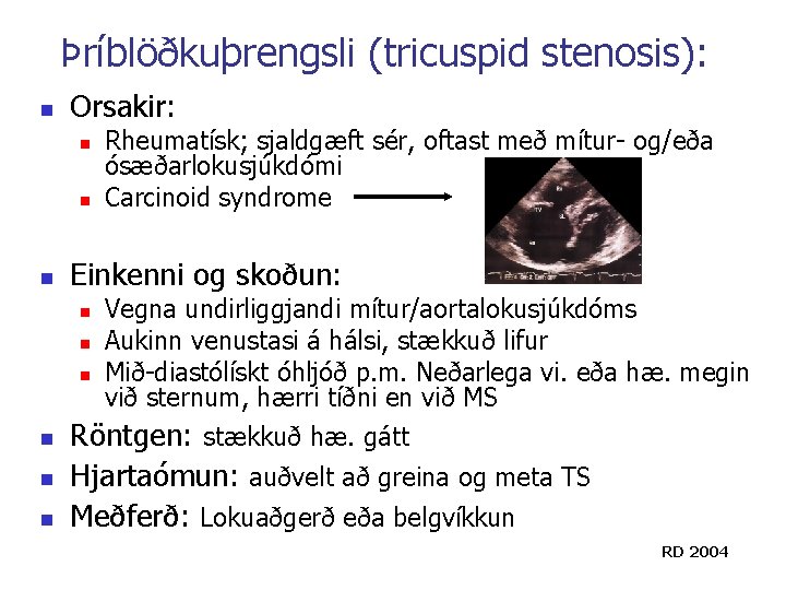 Þríblöðkuþrengsli (tricuspid stenosis): n Orsakir: n n Rheumatísk; sjaldgæft sér, oftast með mítur- og/eða Þríblöðkuþrengsli (tricuspid stenosis): n Orsakir: n n Rheumatísk; sjaldgæft sér, oftast með mítur- og/eða