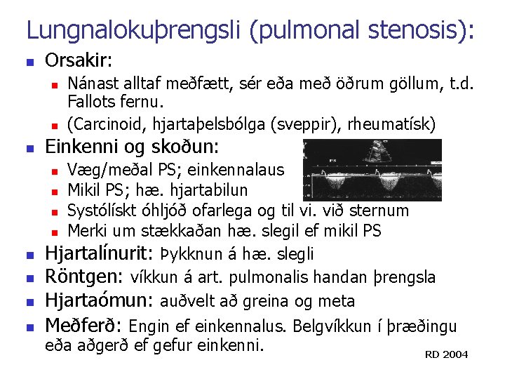 Lungnalokuþrengsli (pulmonal stenosis): n Orsakir: n n n Nánast alltaf meðfætt, sér eða með Lungnalokuþrengsli (pulmonal stenosis): n Orsakir: n n n Nánast alltaf meðfætt, sér eða með