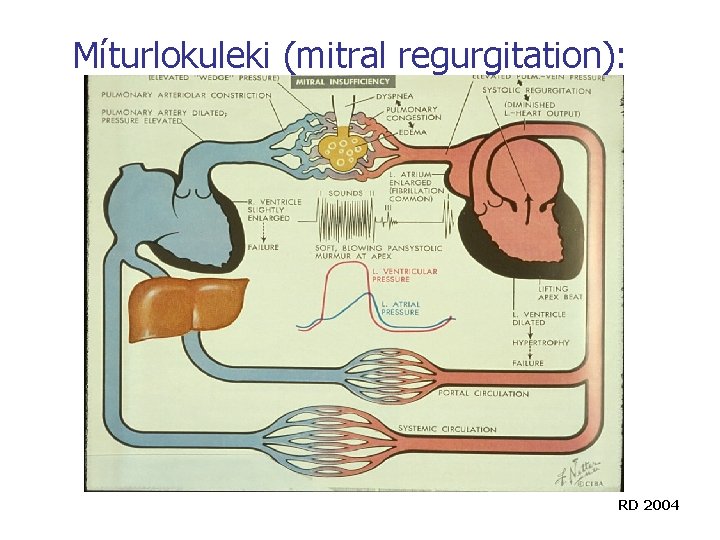 Míturlokuleki (mitral regurgitation): RD 2004 Míturlokuleki (mitral regurgitation): RD 2004