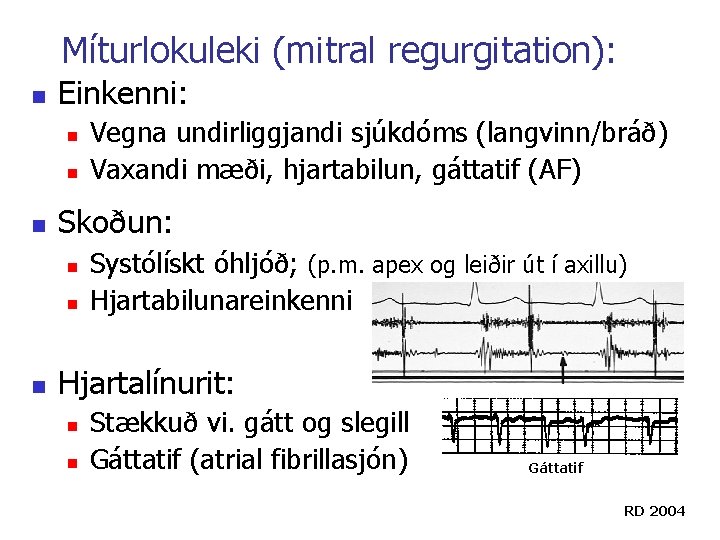 Míturlokuleki (mitral regurgitation): n Einkenni: n n n Skoðun: n n n Vegna undirliggjandi Míturlokuleki (mitral regurgitation): n Einkenni: n n n Skoðun: n n n Vegna undirliggjandi