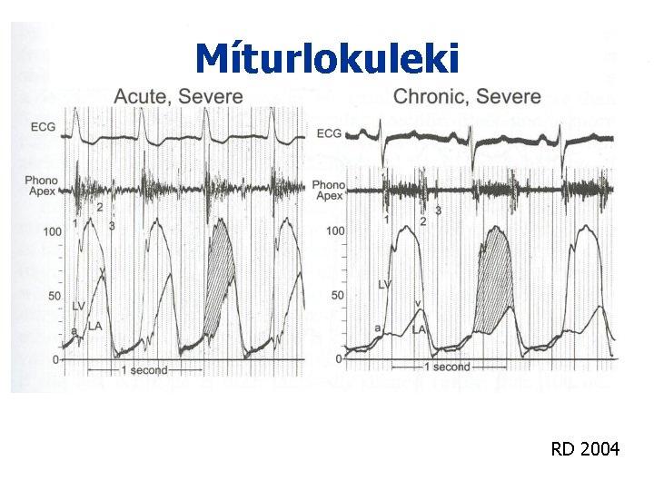 Míturlokuleki RD 2004 Míturlokuleki RD 2004