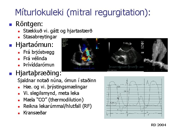 Míturlokuleki (mitral regurgitation): n Röntgen: n n n Hjartaómun: n n Stækkuð vi. gátt Míturlokuleki (mitral regurgitation): n Röntgen: n n n Hjartaómun: n n Stækkuð vi. gátt