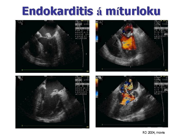 Endokarditis á míturloku RD 2004, movie Endokarditis á míturloku RD 2004, movie