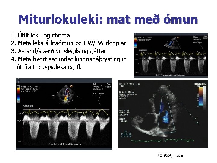 Míturlokuleki: mat með ómun 1. 2. 3. 4. Útlit loku og chorda Meta leka Míturlokuleki: mat með ómun 1. 2. 3. 4. Útlit loku og chorda Meta leka