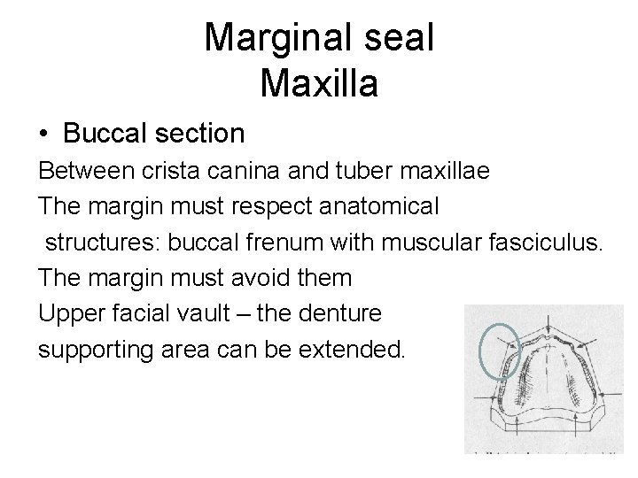 Marginal seal Maxilla • Buccal section Between crista canina and tuber maxillae The margin